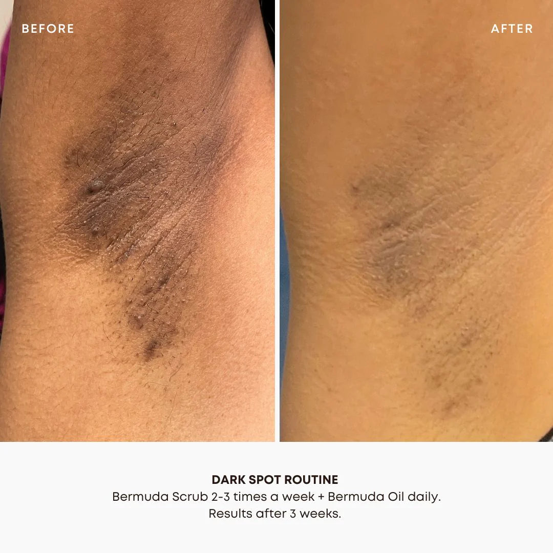 Dark Spot Treatment | 30ml